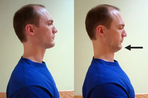 Cervical Retraction