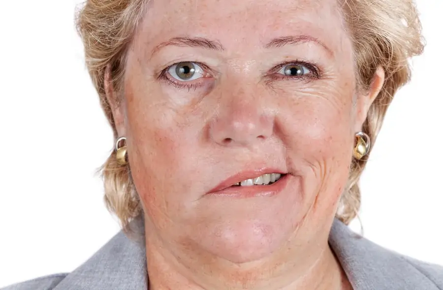 Facial palsy