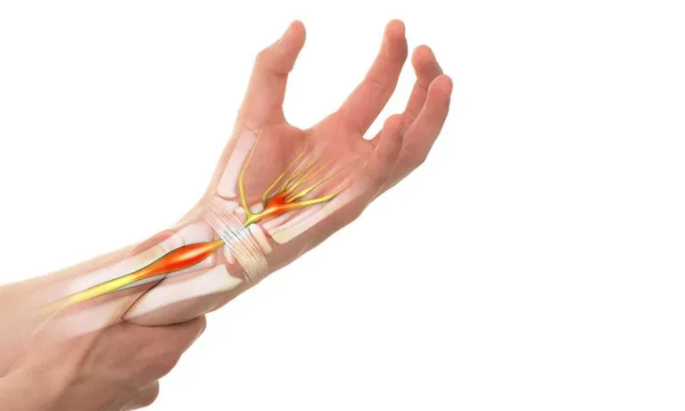 Carpal Tunnel Syndrome