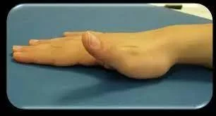 Thumb lifts