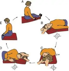 Canalith repositioning procedures (CRPs)