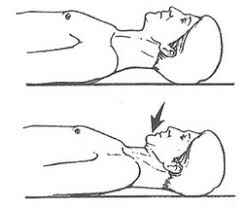 Head retraction